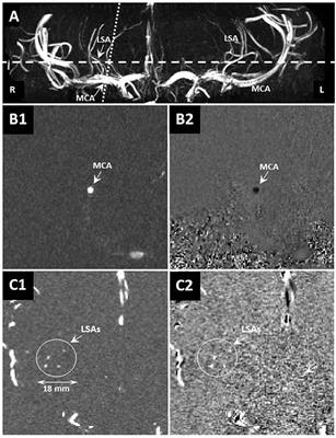 Pulsatility of Lenticulostriate Arteries Assessed by 7 Tesla Flow MRI—Measurement, Reproducibility, and Applicability to Aging Effect
